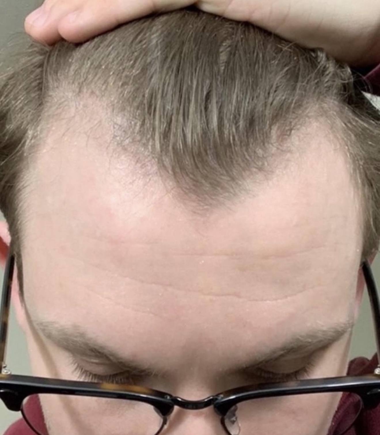 Hair Rescue reference comparison photograph