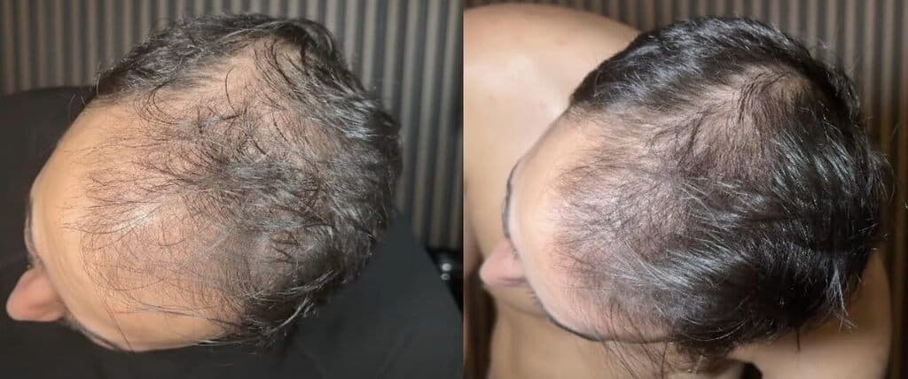 Before and after customer result: Hairline and crown · Customer progress